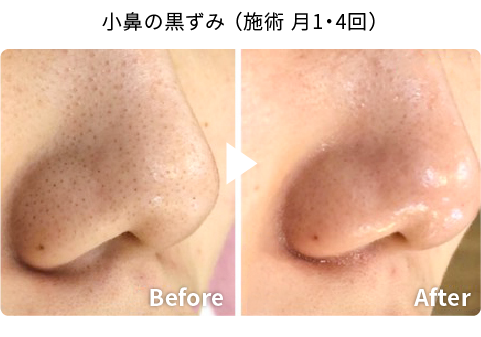 小鼻の黒ずみBefore After（施術 月1・4回）